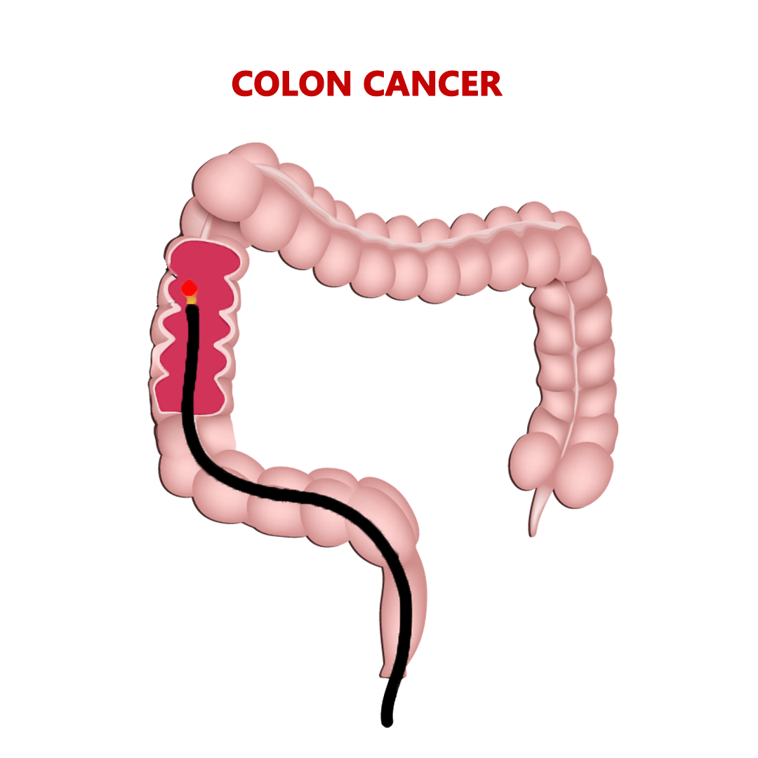Best Cancer Hospital in India | Colon Cancer Treatment in Coimbatore ...
